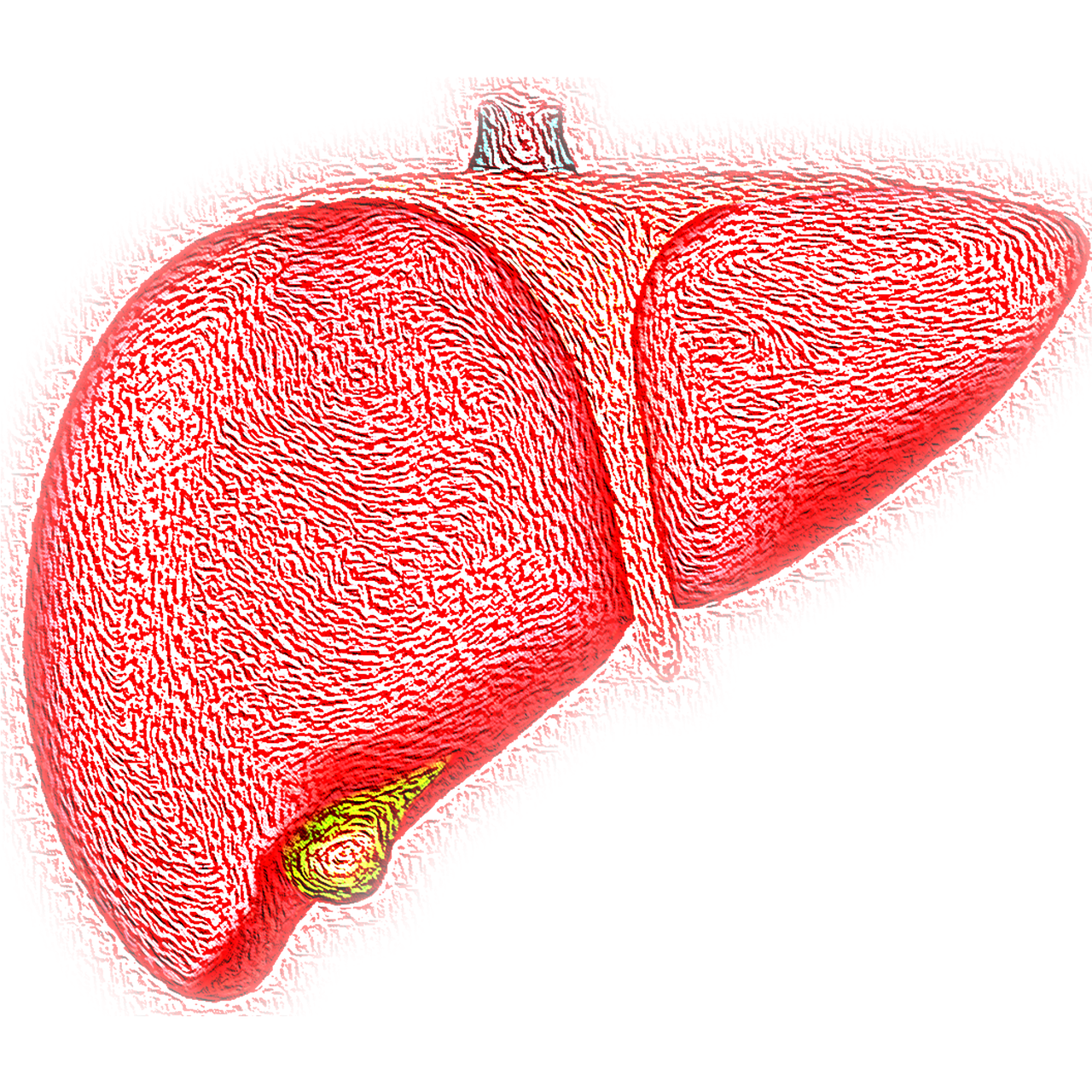 You are currently viewing The Alarming Rise of Non-Alcoholic Fatty Liver Disease in India