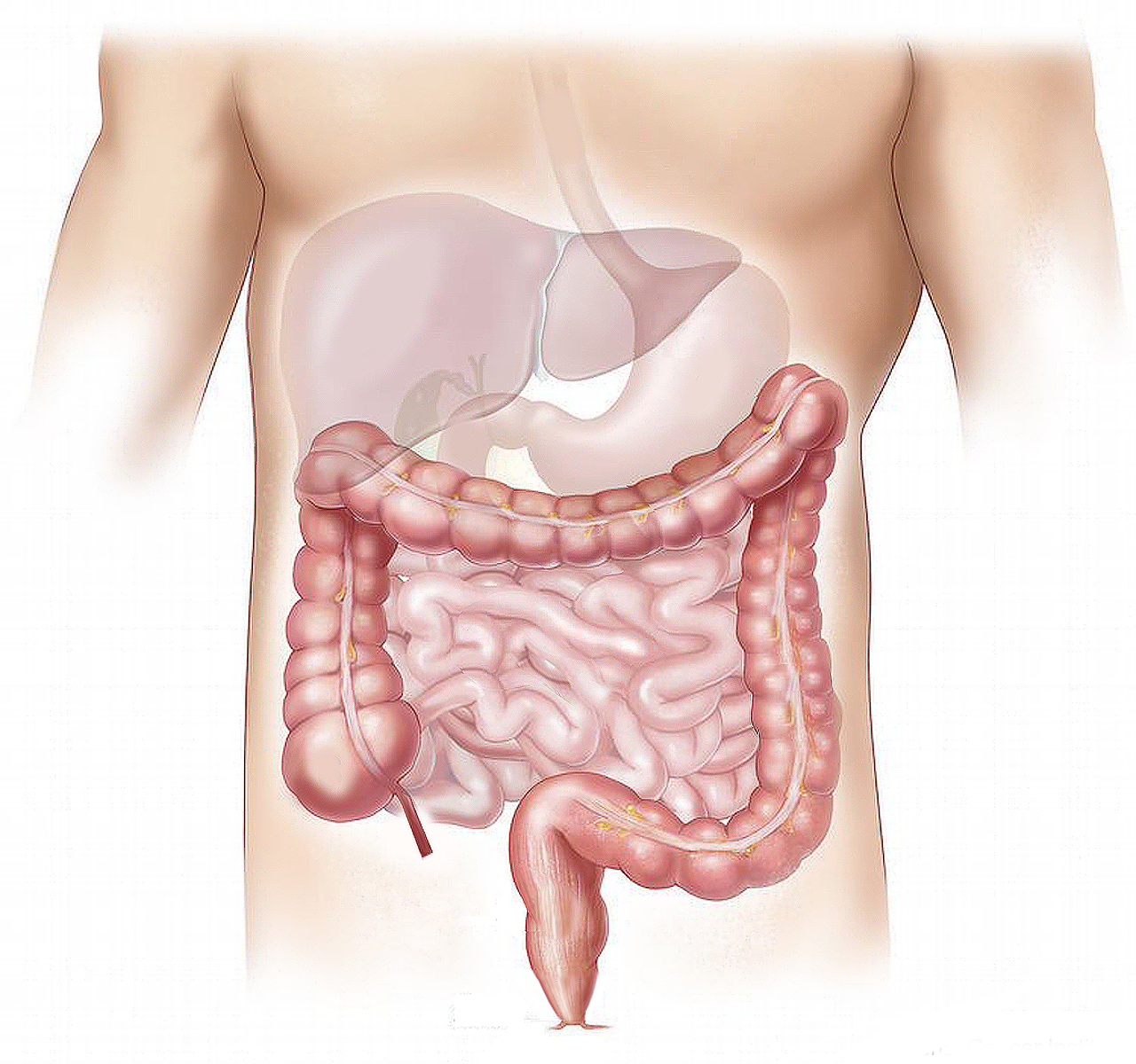 Read more about the article Granuloma in Stoma Patients: Signs, Symptoms, and Prevention Tips